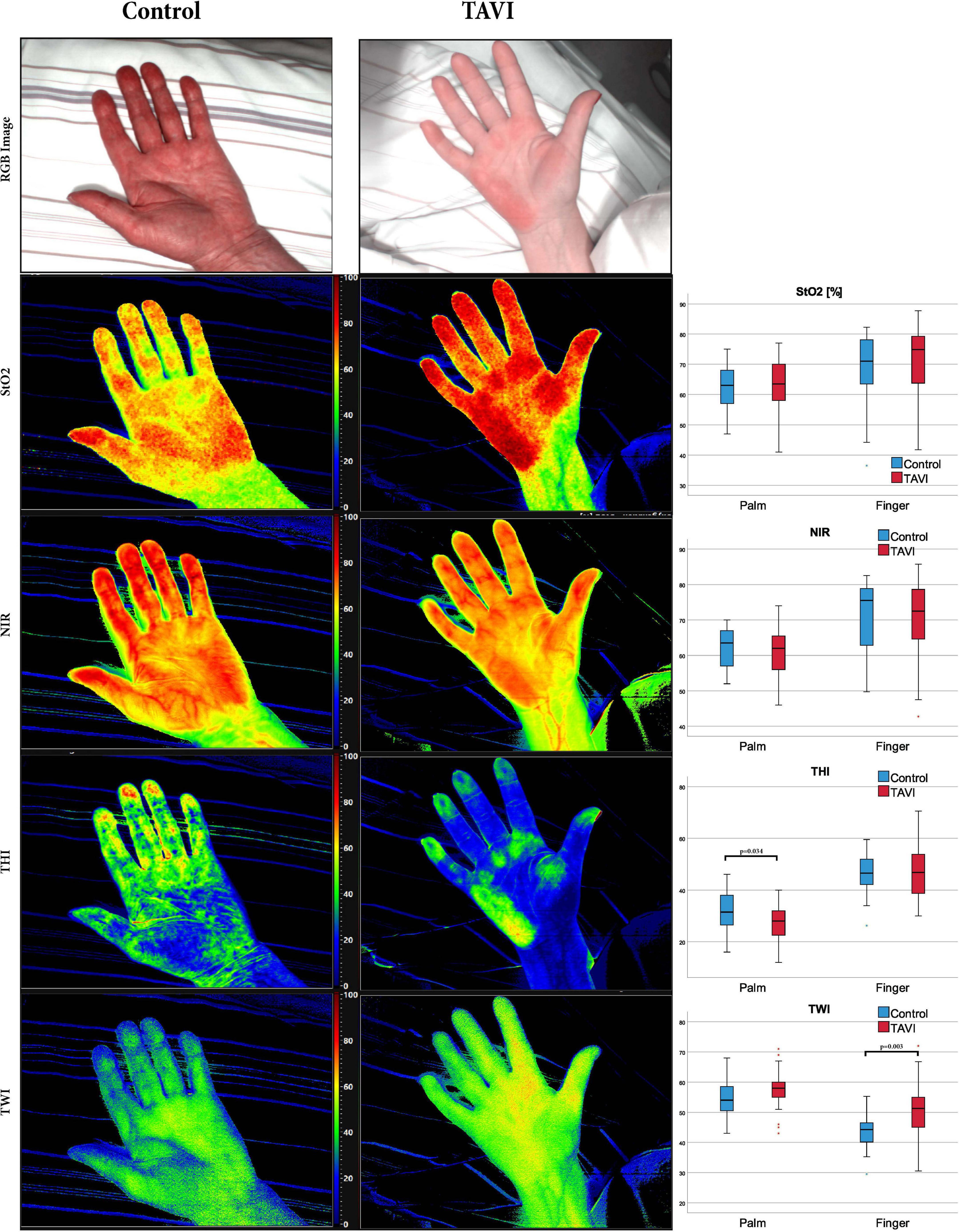 Microcirculatory tissue oxygenation correlates with kidney function after transcatheter aortic valve implantation–Results from a prospective observational study